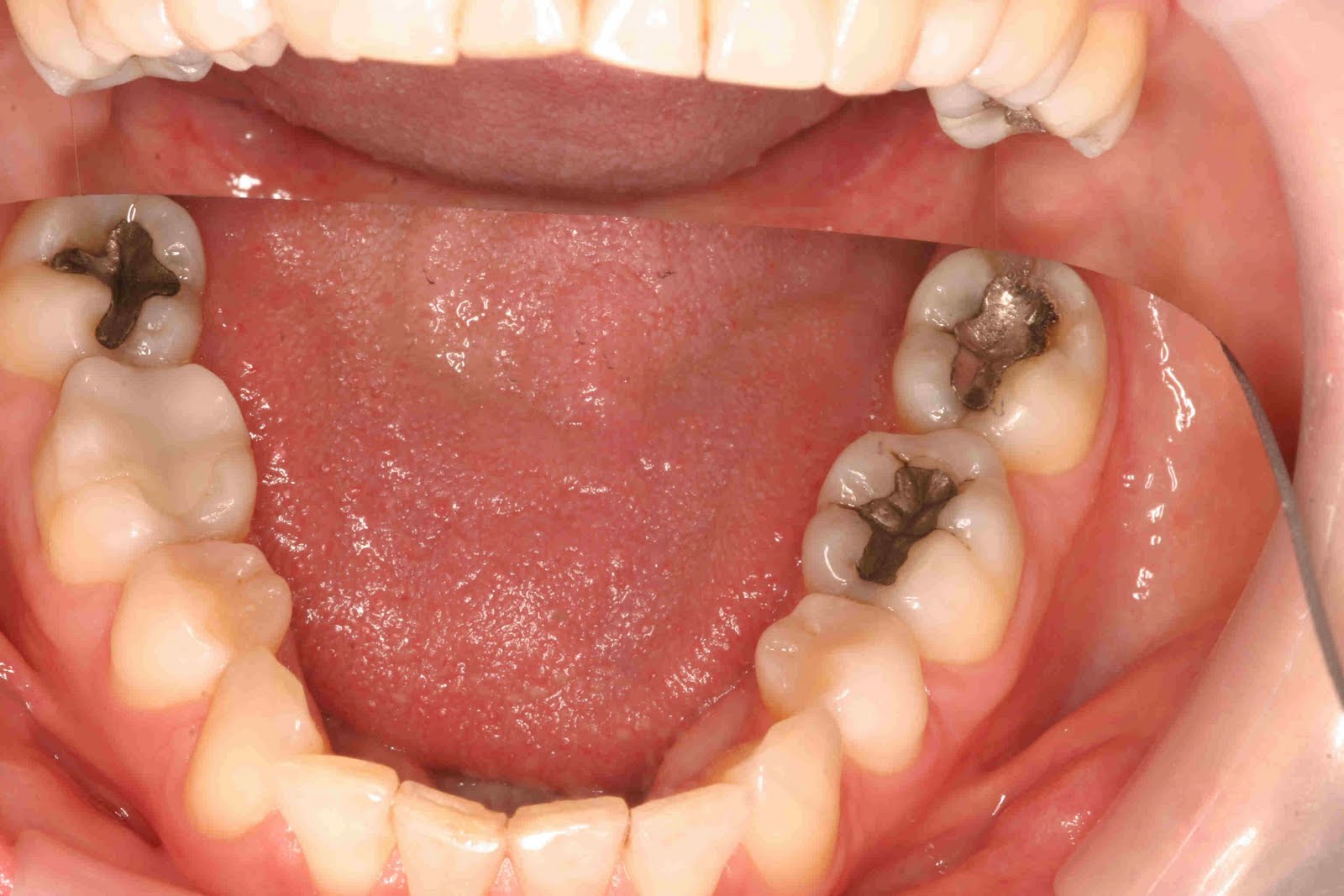 Austin Cosmetic Dentist Lakeway Dentist Dr Tejas Patel Austin