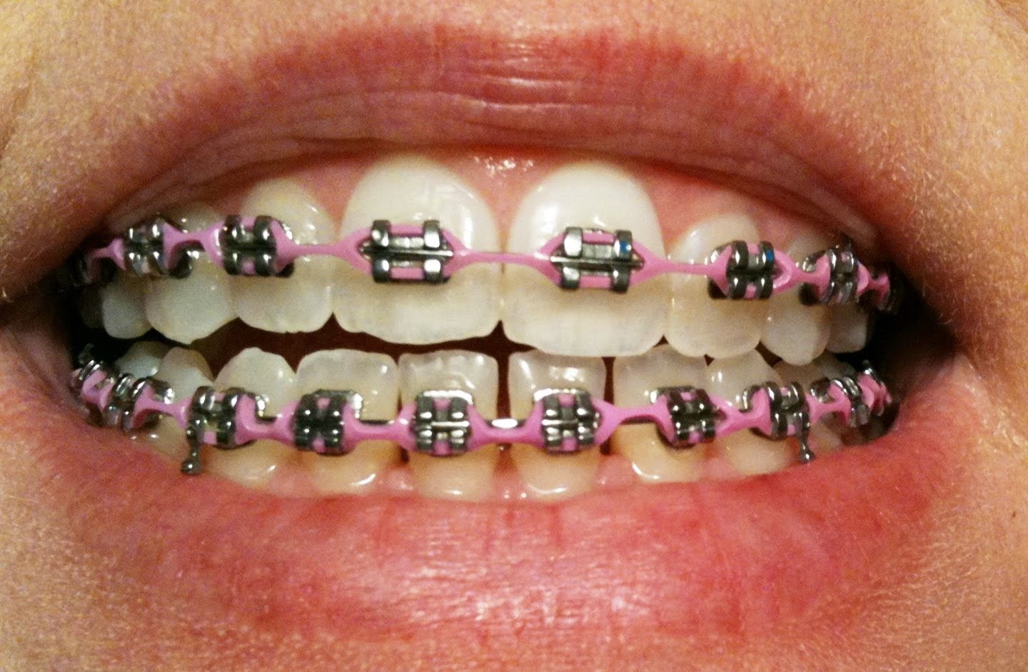 лигатурные и самолигирующие брекеты. металлические безлигатурные брекеты. лигатурные. брекеты металлические безлигатурные damon q. лигатурные.