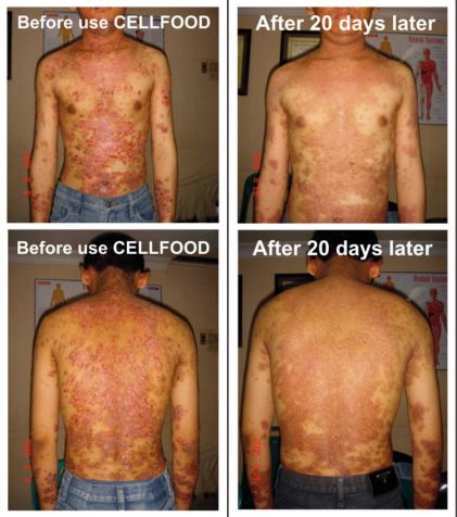 Psoriasis - Cellfood Testimony from Indonesia