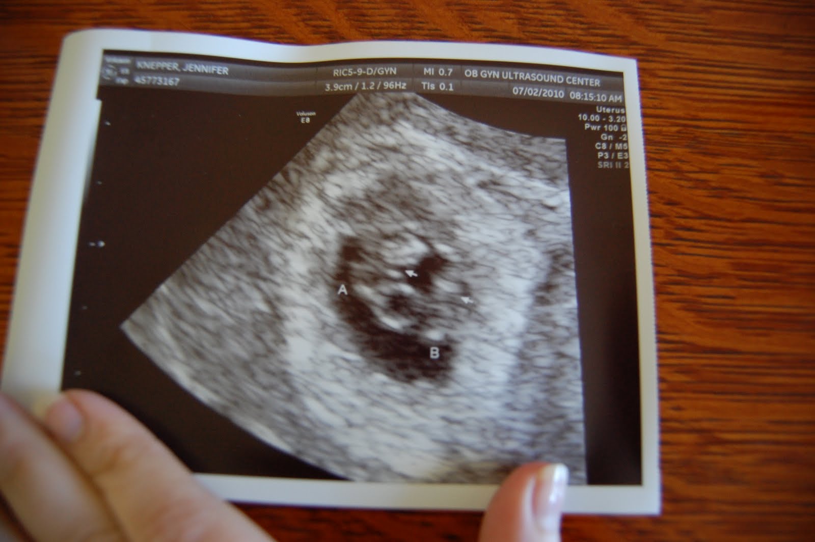 6 недель срок беременной. УЗИ близнецов на 6 неделе беременности. Многоплодная беременность УЗИ 6 недель. УЗИ 5-6 недель беременности двойня. УЗИ 6 недель беременности Близнецы.
