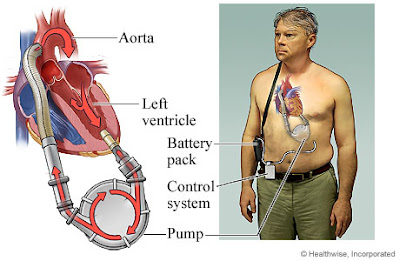 LVAD