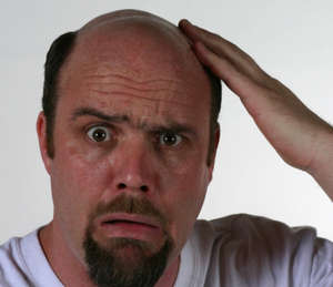 [malepatternbaldness-kellik-kel-sac-dokulmesi.jpg]