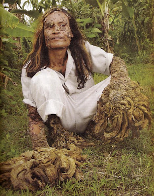 dede tree man. Dede the Indonesian Tree man