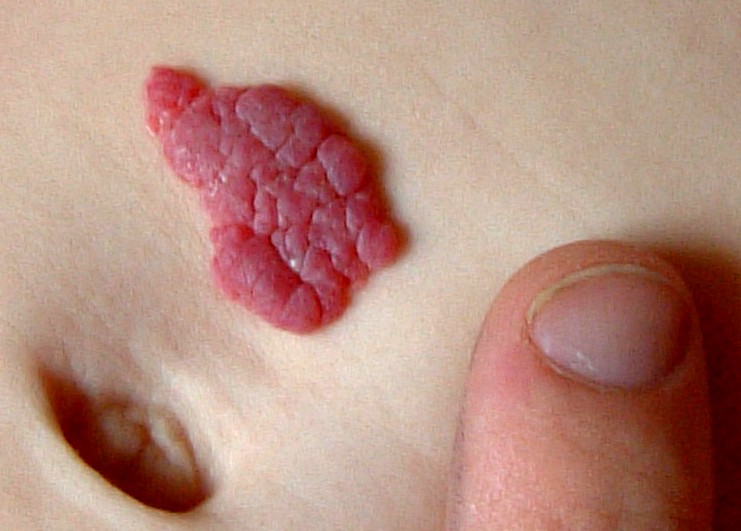 Hemangioma - Wikipedia