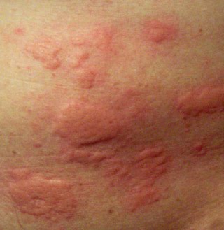 Common Skin Rashes - Skin and Beauty Center - Everyday Health