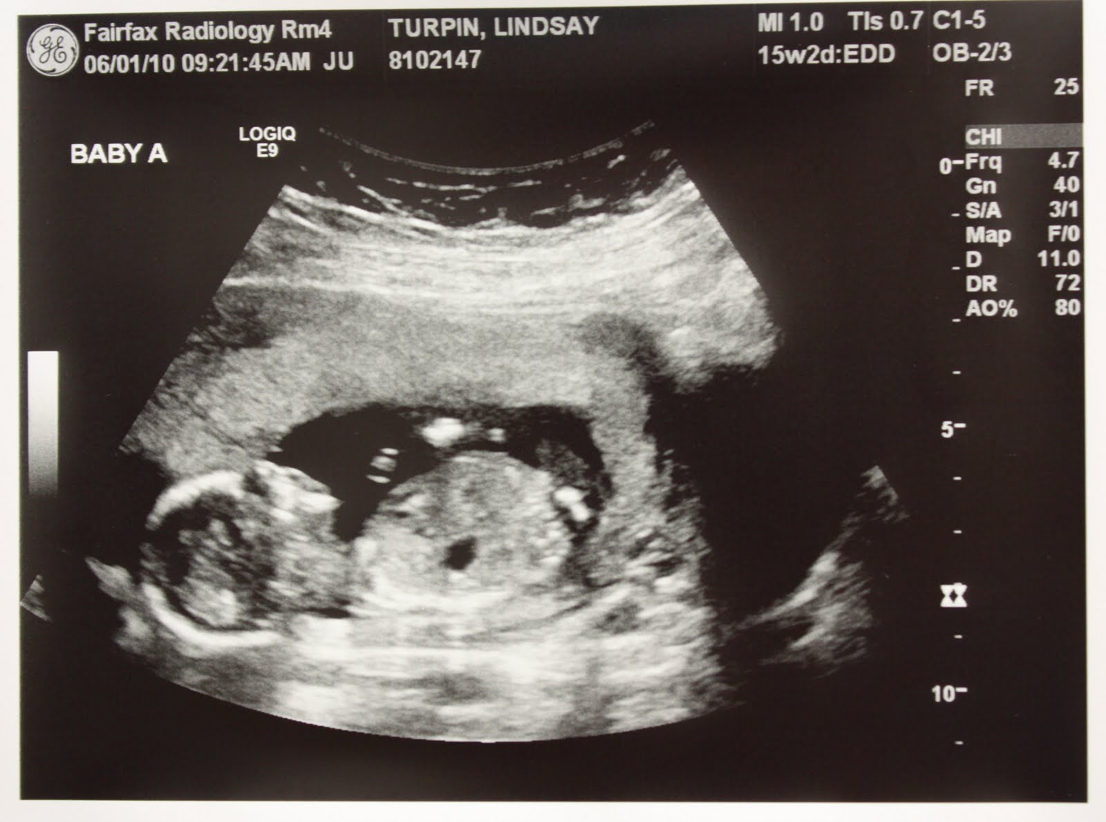 Adventures in Baby Making 16 Weeks Ultrasound Pics