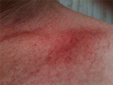 "Angry" clavicle burn