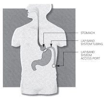 The Gastric Band