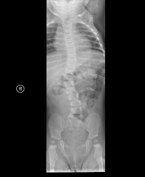 Xray scan of Kaity's back