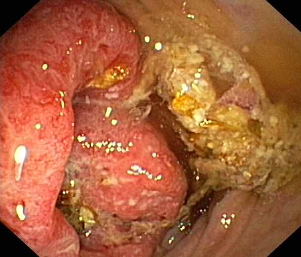 [Kolon+Kanseri+Nedir.jpg]