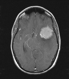 Brain Tumor  1/18/10