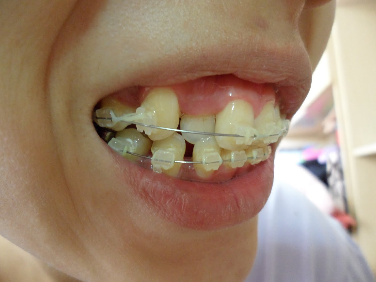 Can I Get Braces on Upper Teeth Only? () Dr