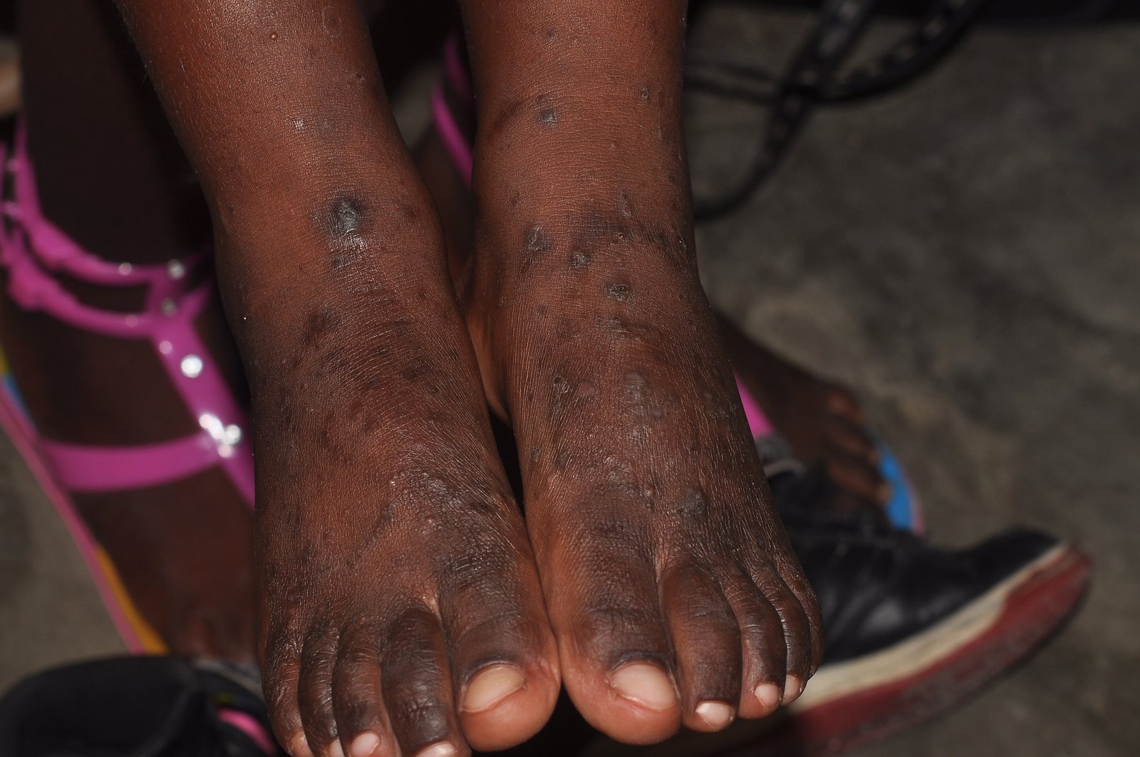 dying-in-haiti-scabies