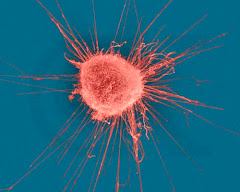 Breast Cancer cell