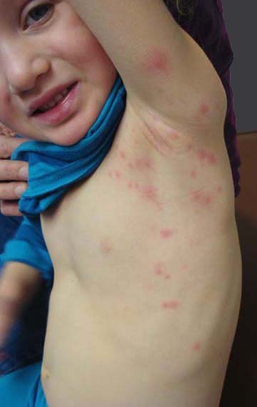 VIRTUAL GRAND ROUNDS IN DERMATOLOGY 2.0: ULE?