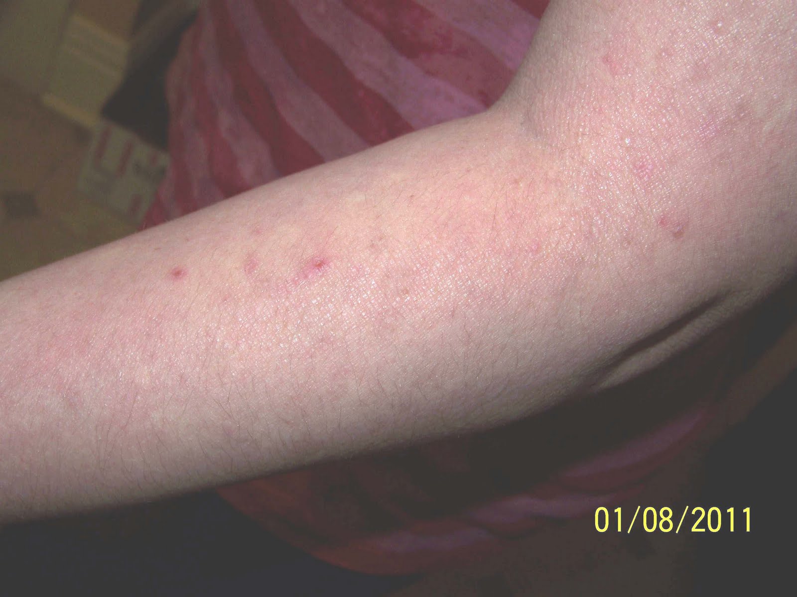 Atopic Skin Disease, Eczema Treatment Guidelines, and ...