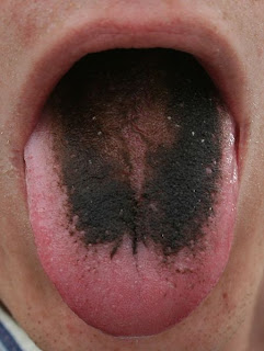 Pepto Bismol Black Tongue 102
