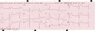 ECG Case study - 001 http://indonersiacenter.blogspot.com/