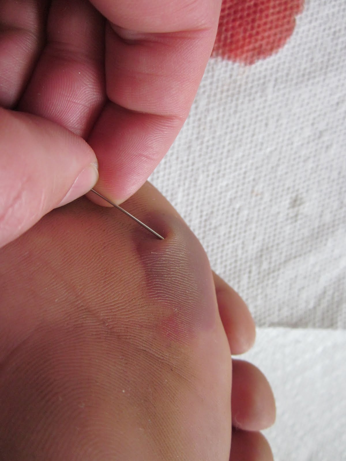 Barefoot Chronicles Proper Care and Feeding of Blisters