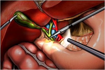 Ramayya Pramila Urology Hospital: Laparoscopic Cholecystectomy: Brief
