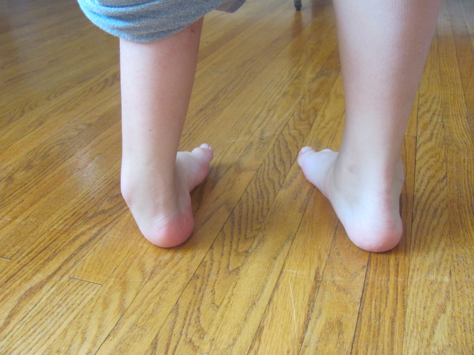 Kate's Blog: Some Pictures of Cassie's left foot the day before surgery