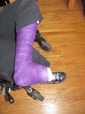 cast fracture clinic trip purple kate