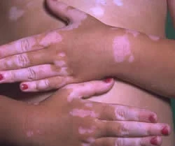 El mal del pinto no es lo mismo que el vitiligo