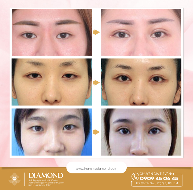 Mở rộng góc mắt những biến chứng có thể gặp phải