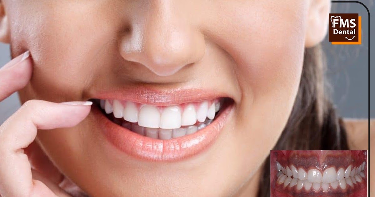 Dark Gums Treatment