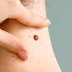 Are you in Search of Best Mole Removal Treatment in Pakistan ?