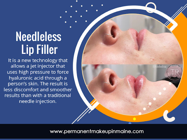 Needleless Lip Filler